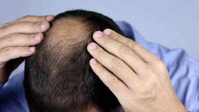 do-hair-loss-medications-affect-male-fertility-risks-and-safer-alternatives-for-men.jpg