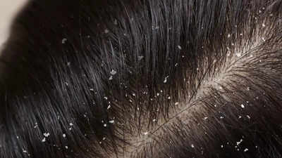 does-coconut-oil-increase-dandruff-the-truth-about-coconut-oil-and-scalp-health.jpg