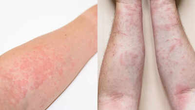 hives-vs-rashes-spot-the-signs-understand-causes-and-tips-to-manage-effectively.jpg
