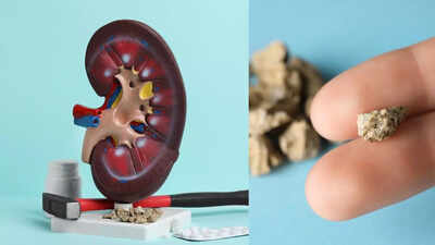 kidney-stone.jpg