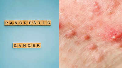pancreatic-cancer-symptoms-on-skin-early-signs-you-shouldnt-ignore.jpg