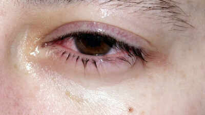 why-do-your-eyes-get-crusty-in-the-morning-causes-treatment-and-when-to-worry.jpg