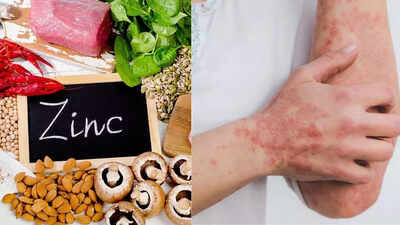 zinc-deficiency-symptoms-that-show-up-on-the-skin-causes-and-remedies.jpg