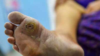 high-blood-sugar-slowly-damages-your-feet-causes-symptoms-and-science-behind-diabetic-foot-ulcers.jp_.jpeg