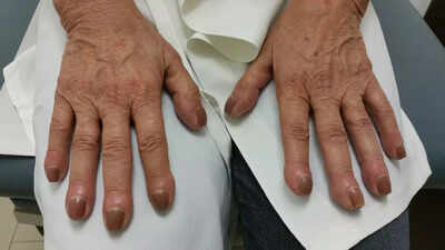lung-cancer-symptoms-on-fingers-finger-clubbing-nail-changes-and-other-warning-signs-that-could-indi.jpeg