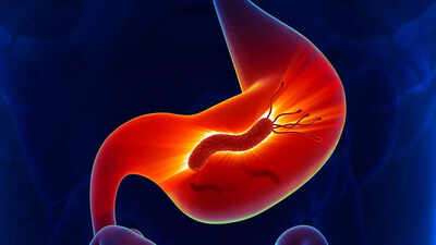 millions-of-stomach-cancer-cases-tied-to-a-common-bacteria-who-is-at-risk-early-detection-and-ways-t.jpeg