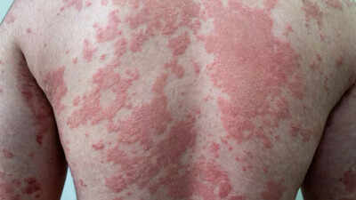 obesity-causes-skin-damage.jpg