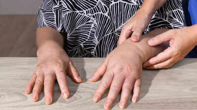 why-your-hands-swell-common-causes-and-treatment-options-for-oedema.jpg