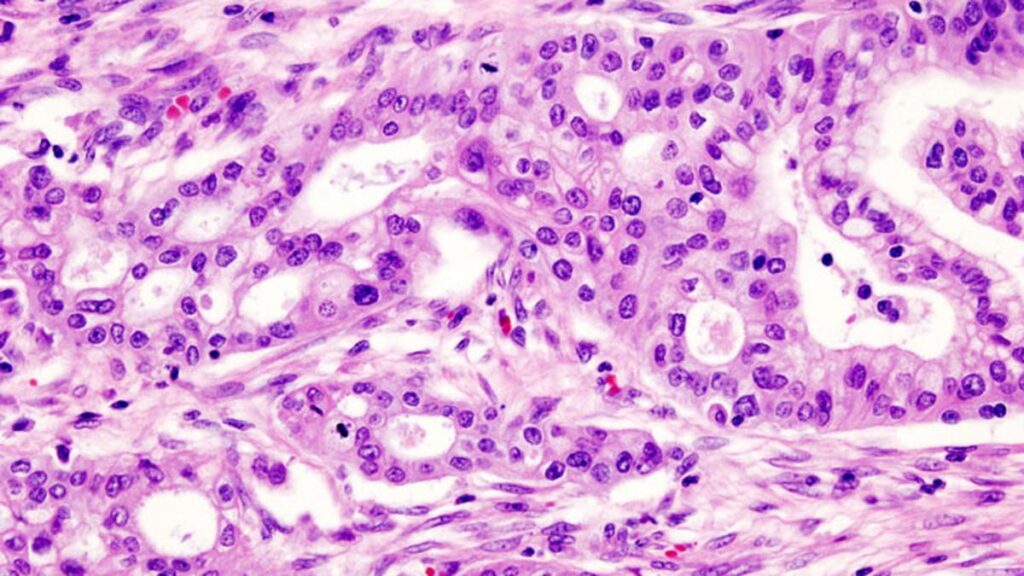 Pancreas_adenocarcinoma_4_Case_01.jpg