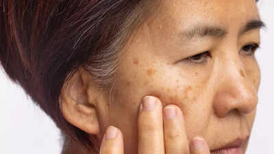 how-vitamin-b12-deficiency-shows-up-on-your-skin-pigmentation-dryness-inflammation-and-other-warning.jpeg