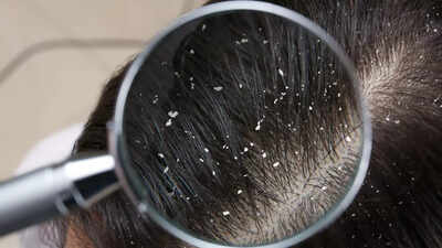 how-zinc-helps-control-dandruff-and-maintain-a-healthy-flake-free-scalp.jpg
