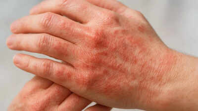 what-your-skin-says-about-your-health-early-signs-of-diabetes-liver-issues-and-autoimmune-diseases.j.jpeg