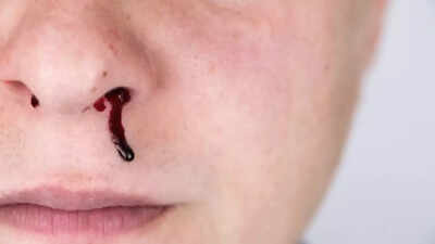 why-your-nose-bleeds-when-you-sneeze-and-how-to-stop-it-common-causes-risks-and-treatment.jpg