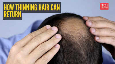 your-hair-can-come-back-doctor-shares-science-backed-plan-to-restore-thinning-hair.jpg