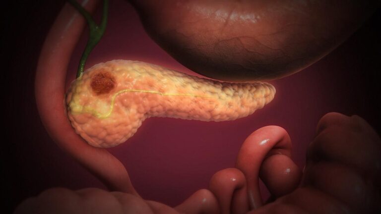Pancreatic_Cancer.jpg