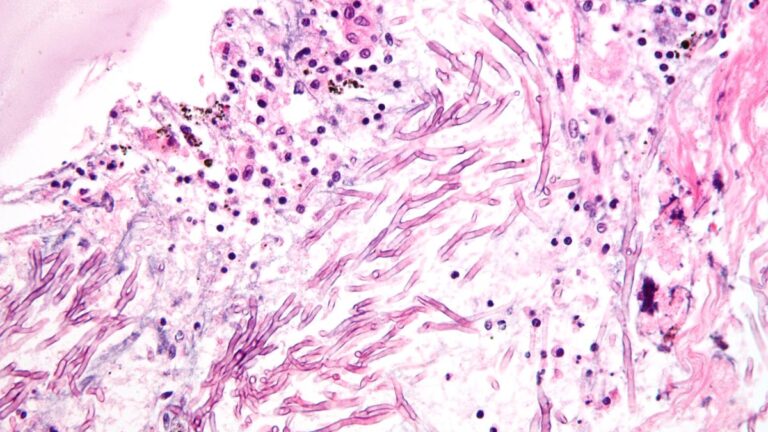 Pulmonary_aspergillosis.jpg